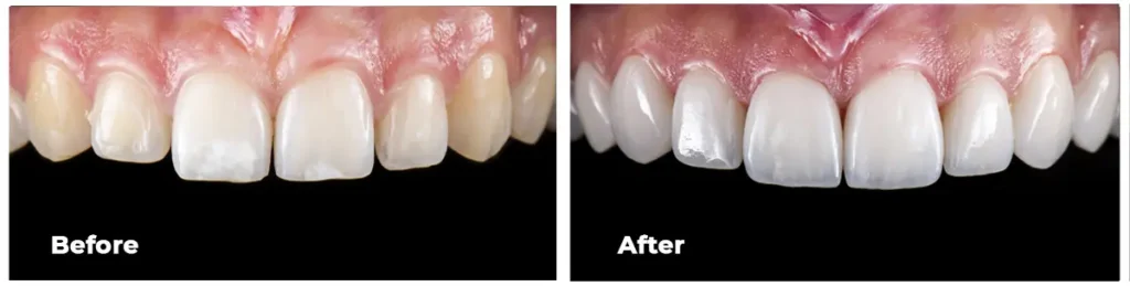 Before & After Porcelain Veneers Patient