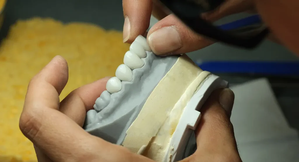 Porcelain Veneers Being Crafted by Master Ceramist